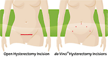 davinci hysterectomy incisions
